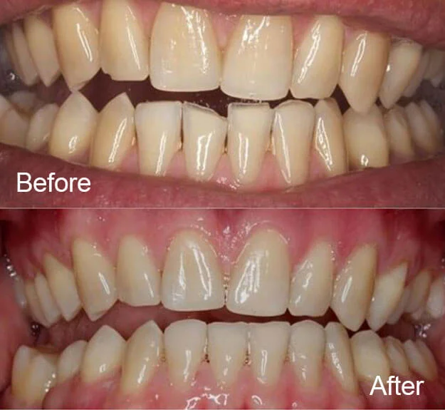 Braces