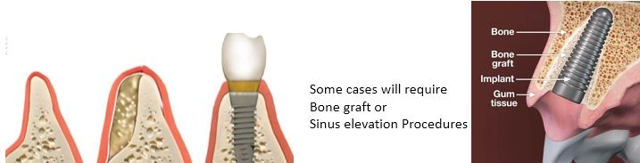 bone-graft Dental Implants
