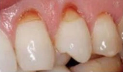 Abrasion
