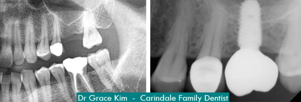 Sinus-Augmentation Dental Implants