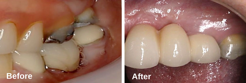 Dentures-replaced-with-Implant-bridge Dental Implants