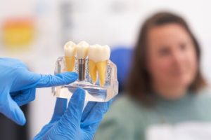 Single Tooth Implant Cost Australia explanation