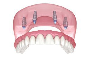 full mouth dental implants cost australia planning