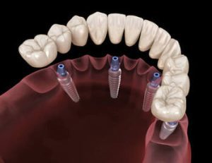 All On 4 Dental Implants placement carindale