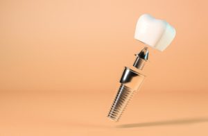 dental implant thailand type carindale