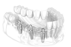 dental implant abroad carindale