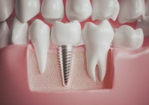 dental implant overseas carindale