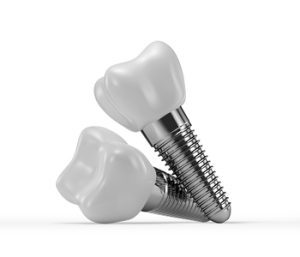 teeth implant in bali carindale