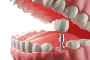 tooth implant in bali carindale
