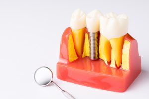 
teeth implant price thailand carindale