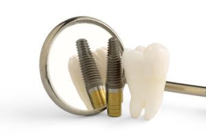
teeth implants thailand carindale