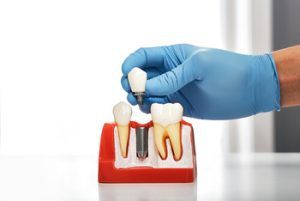 cheap dental implant reasons carindale