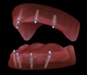 Cost for Full Mouth Dental Implants illustration
