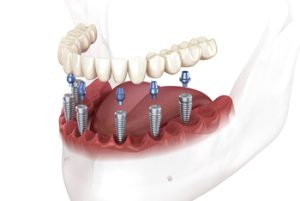 Cost-for-Full-Mouth-Dental-Implants-posts