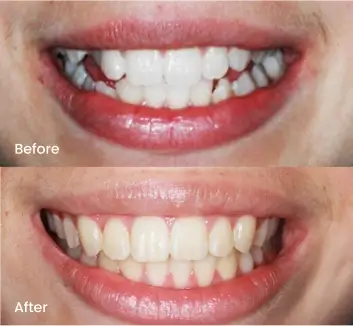 braces-beforeafter-case