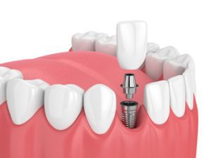 Dental Implants Bangkok procedure