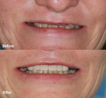 Smile makover - After before