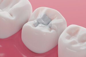 Tooth Sensitivity After a Filling procedure