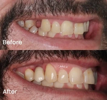 Dental implant case 1 Carindale Dental implant case 1 Carindale