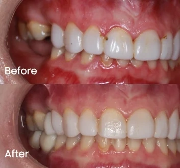 Dental implant case 3 Carindale Dental implant case 3 Carindale