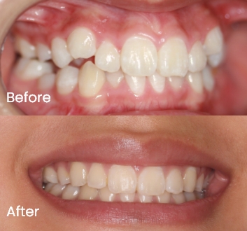 Orthodontics case 2 Carindale