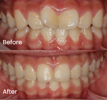Orthodontics case 3 Carindale