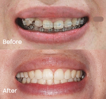 Orthodontics case 4 Carindale