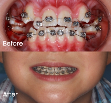 Orthodontics case 5 Carindale