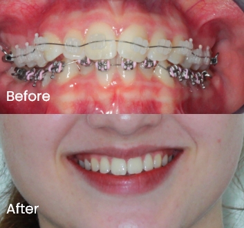 Orthodontics case 6 Carindale