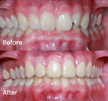 Orthodontics case 7 Carindale