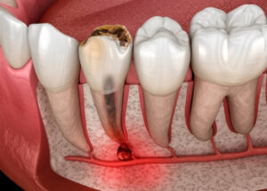 Sore Tooth After Root Canal pain Sore Tooth After Root Canal pain