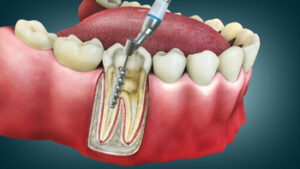Sore Tooth After Root Canal procedure Sore Tooth After Root Canal procedure