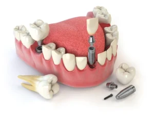 Dental Implants Cost Per Tooth number Dental Implants Cost Per Tooth number