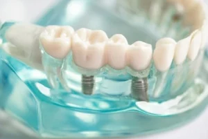 Dental Implants check Dental Implants check