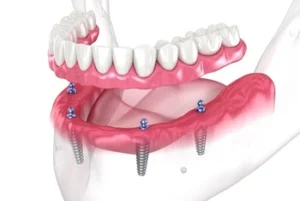 Dental Implants full Dental Implants full