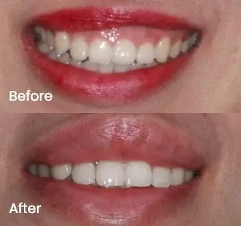 Gummy Smile Treatment Case 1