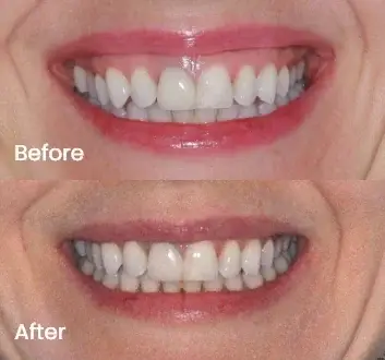 Gummy Smile Treatment Case 4