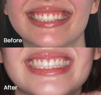 Gummy Smile Treatment Case 6