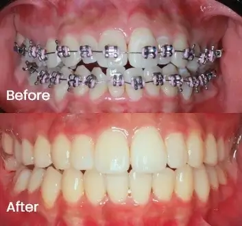 Orthodontics Case