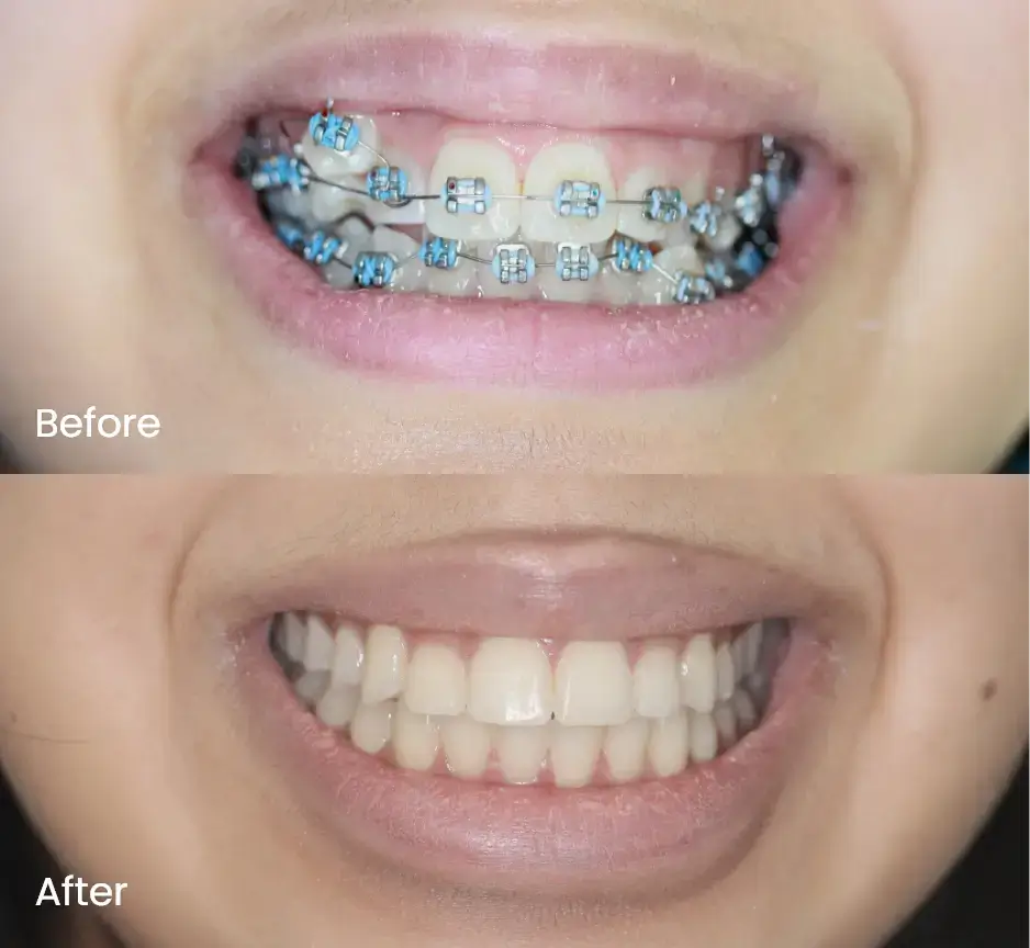 Orthodontics Case