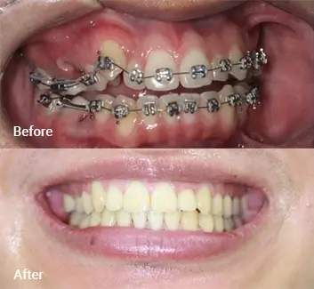 Orthodontics Case