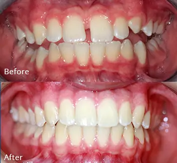 Orthodontics Case