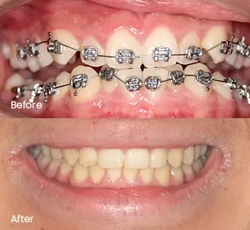 Orthodontics Case