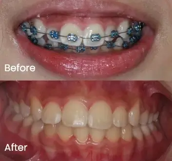 Orthodontics Case