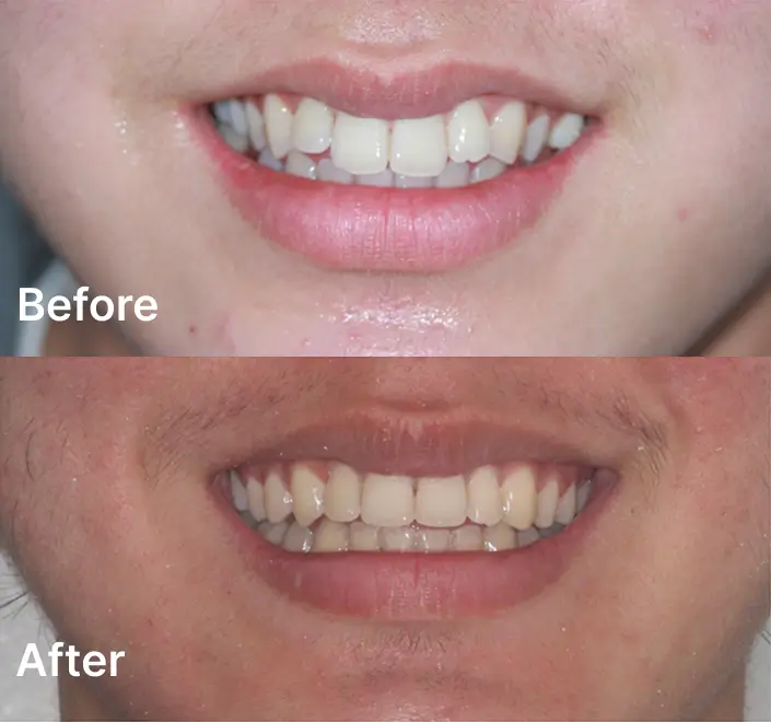 Orthodontics Case Carindale