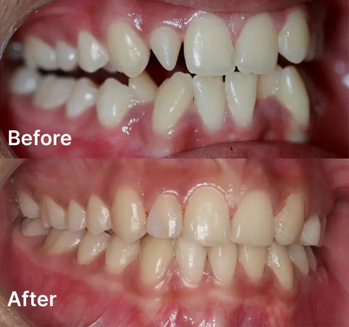 Orthodontics case 8 Carindale