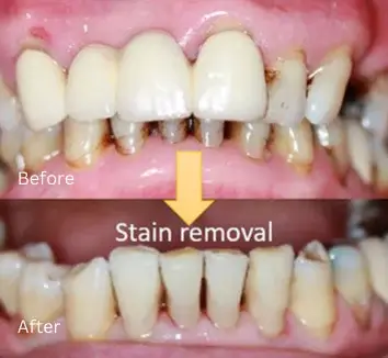 Periodontics Case 2