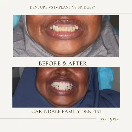 Replacing Missing Teeth Case