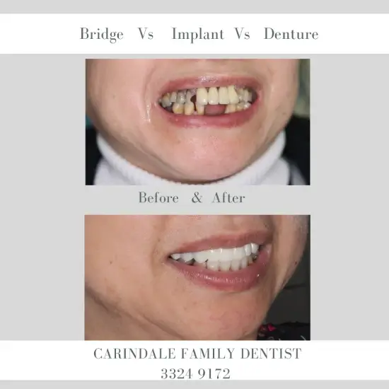 Replacing Missing Teeth Case