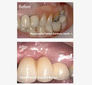 Replacing Missing Teeth Case